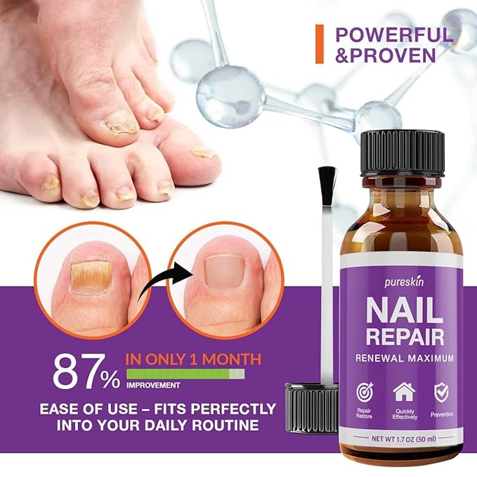 Toenail Fungus Treatment Extra Strength: Nail Fungus Treatment for Toenails and Fingernail for Damaged Discoloration Nails 1.0 Oz (New Formula)