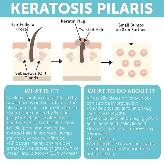 Keratosis Pilaris Treatment | Keratosis Pilaris Lotion with 10% AHA | Gentle Exfoliation For Strawberry Legs, KP & Ingrown Hairs | Smooth & Hydrating Body Lotion For Redness, Dry, Rough And Flaky Skin