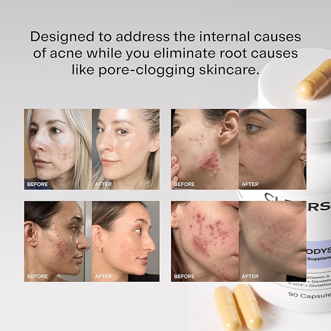 CLEARSTEM - MINDBODYSKIN Hormonal Acne Supplement (5-HTP) - Natural DIM Supplement - Skin Care Vitamins - Hormone Balance, Antioxidants - Gluten Free, Cruelty Free - 60 Servings, 180 Capsules