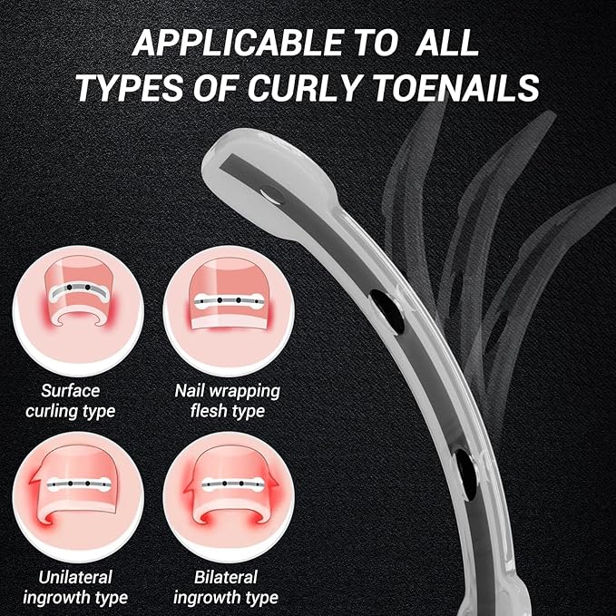 Titanium Alloy Ingrown Toenail Treatment, Nail Tools, and Ingrown Toenail Removal Kit Specially Designed for Curved Nail Repair and Ingrown Toenail Corrector (0.59/0.67in)