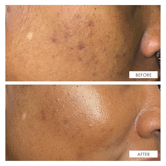 111SKIN Dark Spot Correcting Serum for Face, Hydrating Serum for Dark Spots, Acne Scars & Uneven Skin Tone with Tranexamic Acid & Niacinamide, Suitable for All Skin Types, 1 fl oz