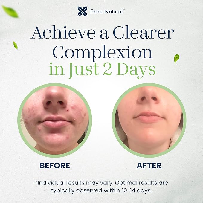 ExtraNatural Acne Cream – Natural & Gentle Acne Treatment for Sensitive & Oily Skin – Helps Reduce Breakouts, Pimples & Redness