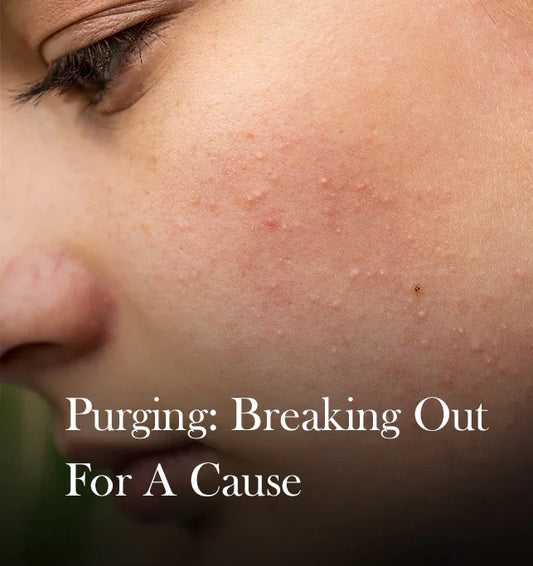 Skin Purging or Breakout? How to Tell the Difference (Before You Quit Your Products)