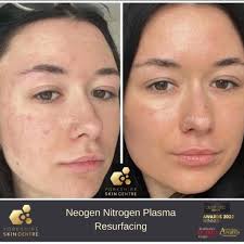 How to Get Rid of Dark Spots: The Skincare Routine Women Swear By