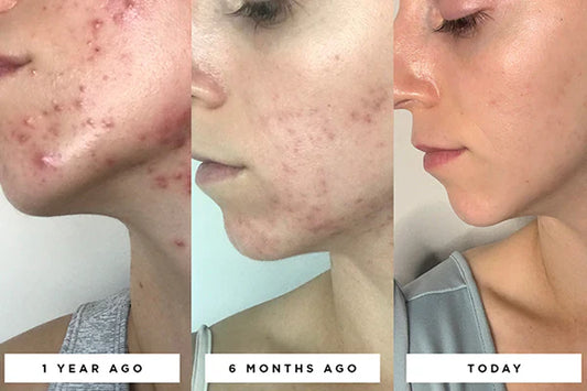 How to Build a Skincare Routine for Oil & Acne-Prone Skin (2026 Guide)