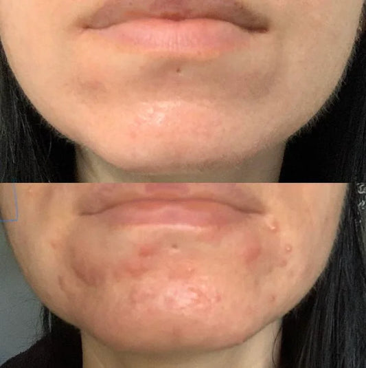 How Long Does It Take to Clear Hormonal Acne?