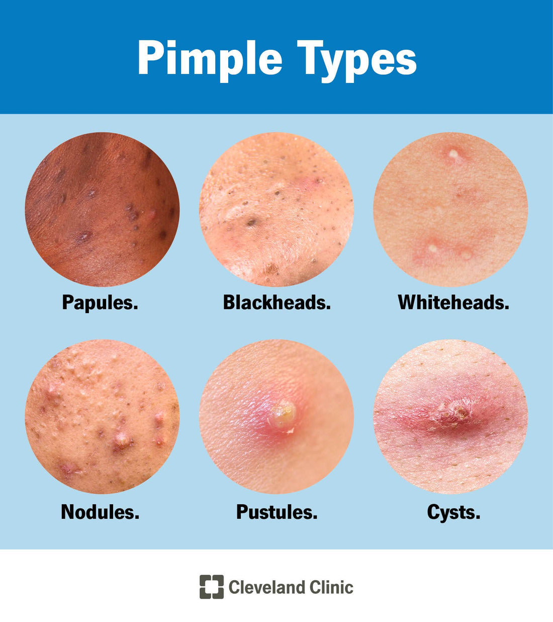 Why Your Acne Won’t Go Away