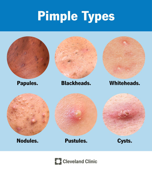 Why Your Acne Won’t Go Away