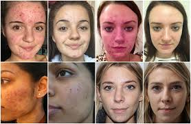 Best Acne Treatment Products That Actually Work (2026 Guide for Clear Skin)