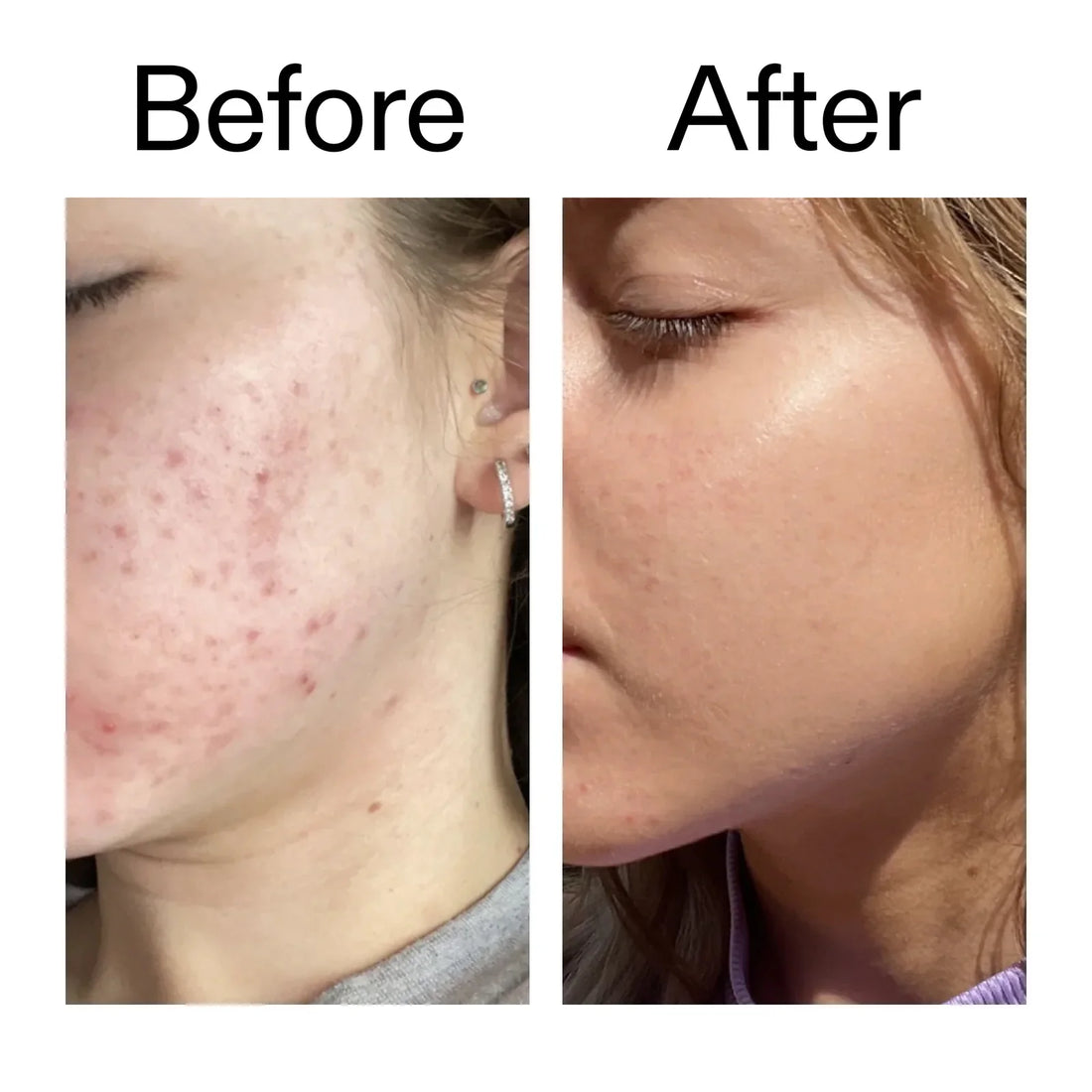 Why Is Niacinamide Breaking Me Out? (Purging or Irritation?)