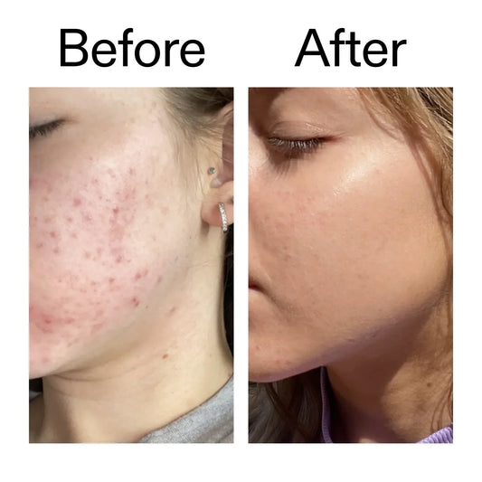 Why Is Niacinamide Breaking Me Out? (Purging or Irritation?)