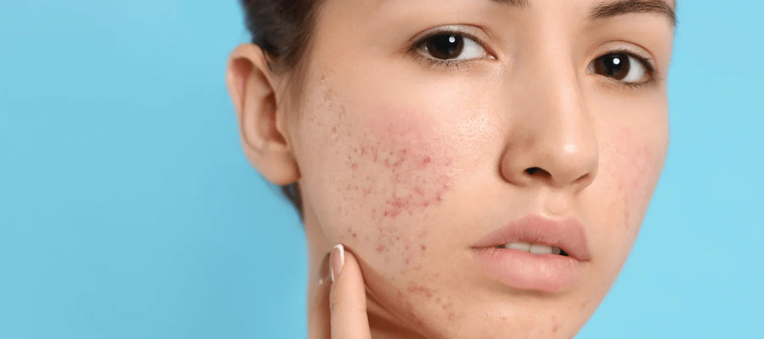 Damaged Skin Barrier + Acne? The Safe Routine for Sensitive, Breakout-Prone Skin (2026 Guide)