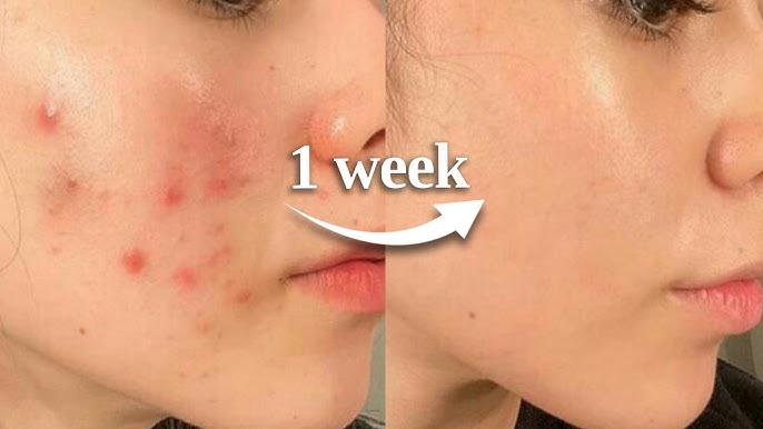 How to Repair a Damaged Skin Barrier (Dermatologist Guide)