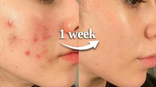 How to Repair a Damaged Skin Barrier (Dermatologist Guide)