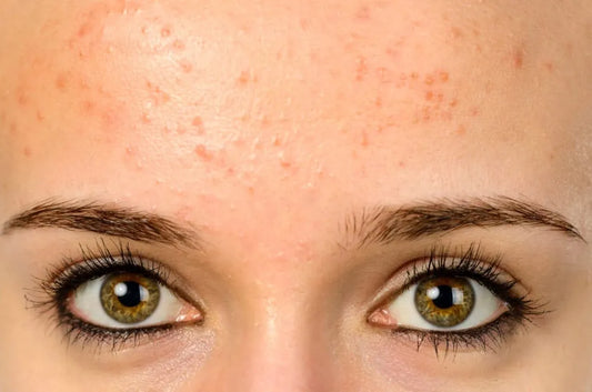 Tiny Forehead Bumps That Won’t Go Away? It Might Not Be Acne.
