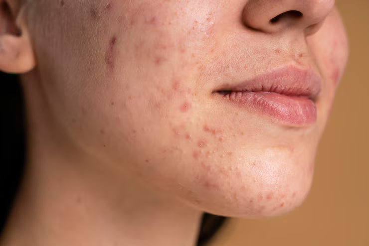 Why Your Acne Won’t Heal: It’s Not Oil, It’s Your Skin Barrier