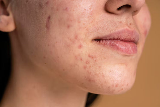 Why Your Acne Won’t Heal: It’s Not Oil, It’s Your Skin Barrier
