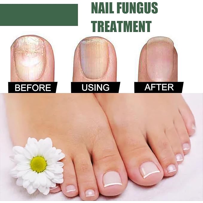 Cure nail Fungus Treatment Extra Strength,Gray Nail Liquid External Use Health Care Hand and Foot Thickening Brightening Gray Nail Foot Care Liquid，30ml/pcs