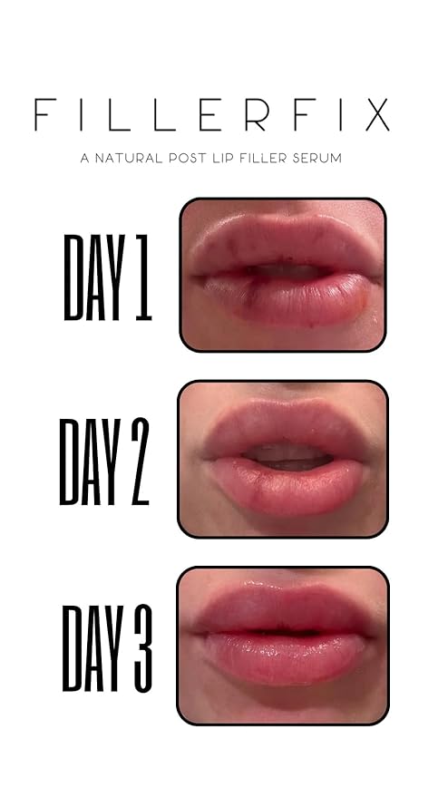 Organic Lip Filler Aftercare Serum with Cooling Ceramic Tip – Arnica & Calendula for Relief After Lip Filler