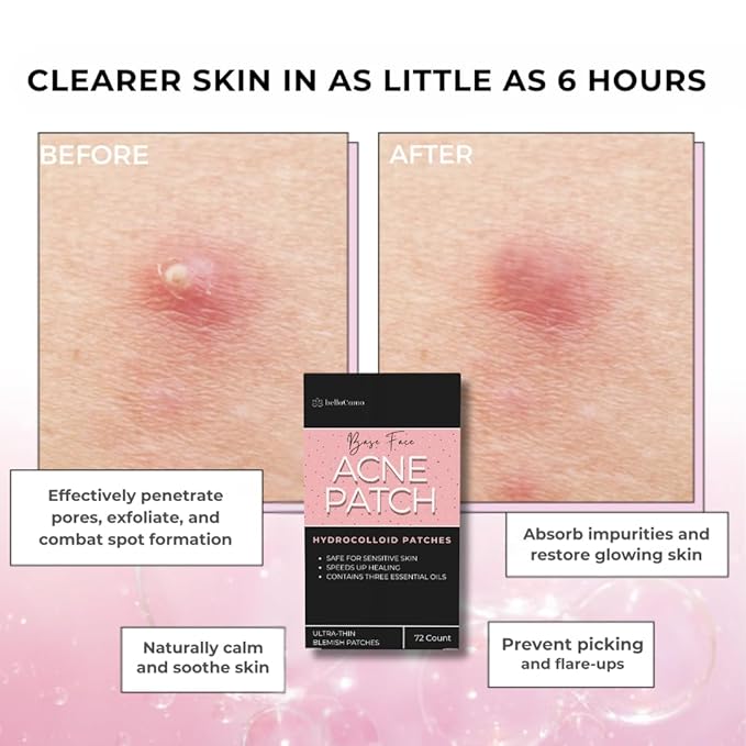 Pimple Patches – Hydrocolloid Acne Patches for Zits, Whiteheads & Blemishes, Fast Healing Zit Stickers, Invisible Pimple Spot Treatment for Face, Day or Night Use- 72 Count