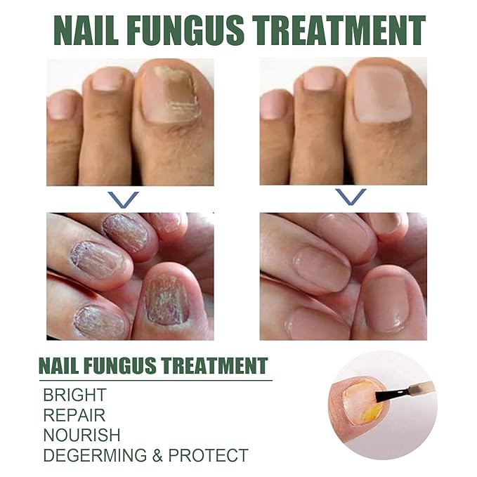 Cure nail Fungus Treatment Extra Strength,Gray Nail Liquid External Use Health Care Hand and Foot Thickening Brightening Gray Nail Foot Care Liquid，30ml/pcs