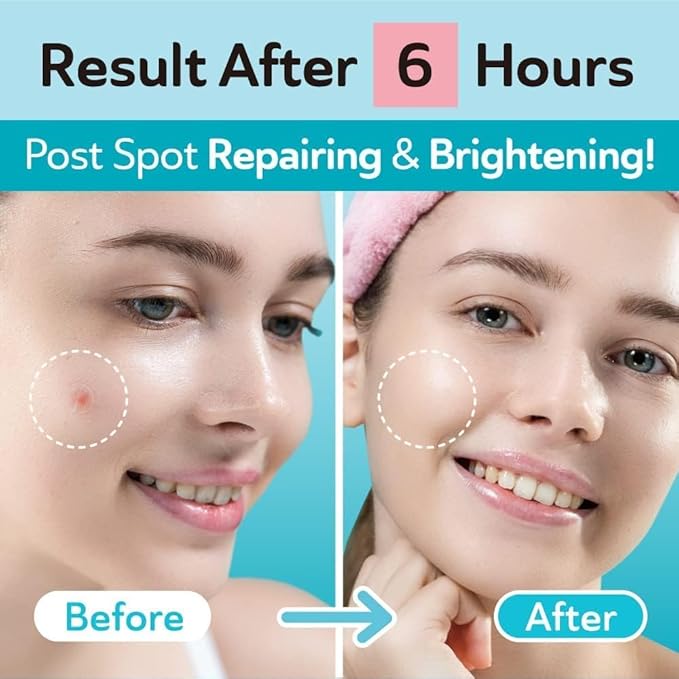 Ultra Invisible Dark Spot Patches for Post Acne and Ultra Invisible Salicylic Acid Acne Patches for Cystic Acne – Spot Treatment for Face with Hydrocolloid – 228 Count, Day & Night Use Bundle