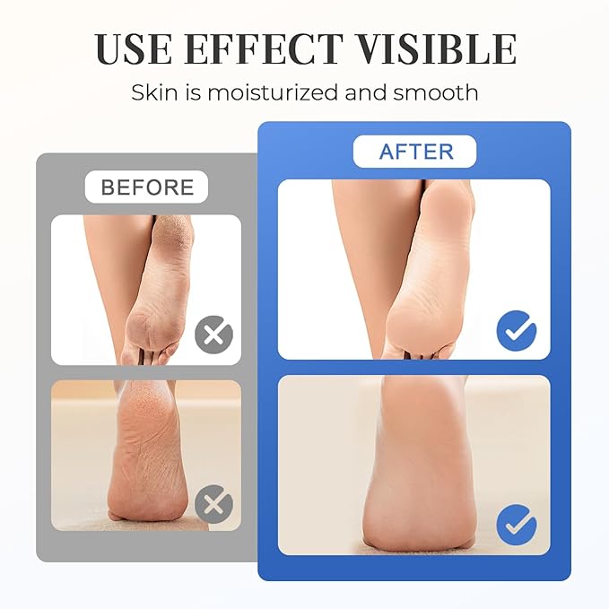 Hydrating and Anti-Cracking Foot Cream, 2025 Moisturising and Relieves Cracking and Dryness Foot Cream, Hand and Foot Repair Cream for Women & Men Callused, Feet, Knee, Elbow, Hand (Blue-1PC, #01)