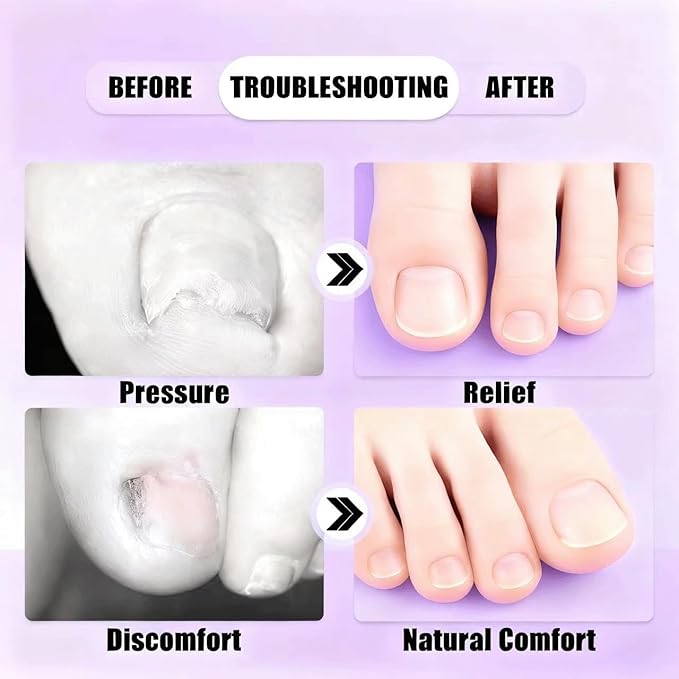 Ingrown toenail removal kit (Type A): Contains corrector, breathable/curved corrector strips, painless file, nail remover and pedicure tools, suitable for both men and women.