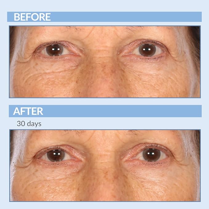 Serious Skincare - Retinol A Eye XR Under Eye Cream Concentrate - Reduce Fine Lines, Dark Circles & Puffiness - Daily Wrinkle Cream - Anti-Aging Skin Care Treatment for Women and Men - 0.5 oz