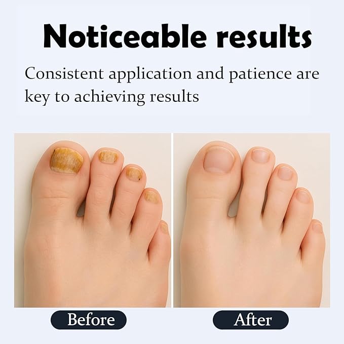Nail Repair Pen,Toenail Fungus Pen Extra Strength Nail Repair and Renew Discolored, Damaged, Broken and Thick Nails Toenails, Tea Tree Oil, Honey, Natural Formula - 3PCS