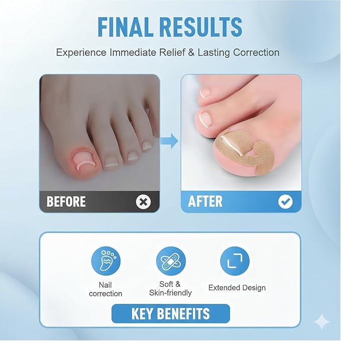 Ingrown Toenail Removal Kit, Professional Ingrown Toenail Corrector Set with Toenail Correction Strips, Curved Toenails Corrector Patch, Painless File and Lifter Pedicure Tools for Home Treatment