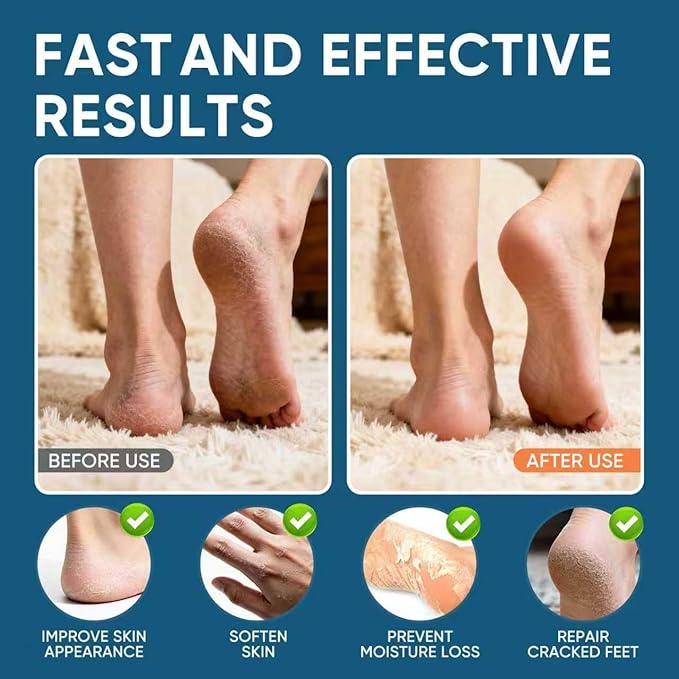 Urea Cream 60% Plus Salicylic Acid 2%, Urea Cream 60 Percent for Feet Maximum Strength, Foot Cream for Dry Heels Cracked