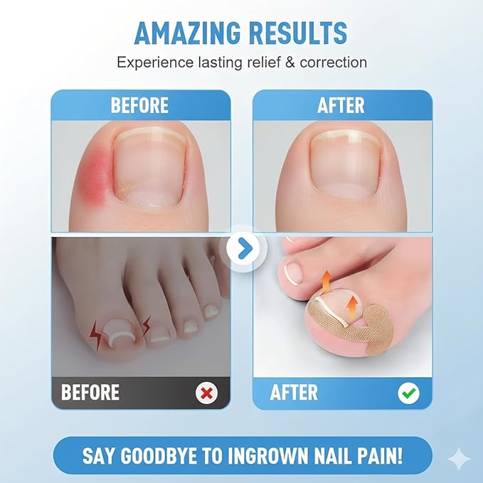 Ingrown Toenail Removal Kit, Professional Ingrown Toenail Corrector Set with Toenail Correction Strips, Curved Toenails Corrector Patch, Painless File and Lifter Pedicure Tools for Home Treatment