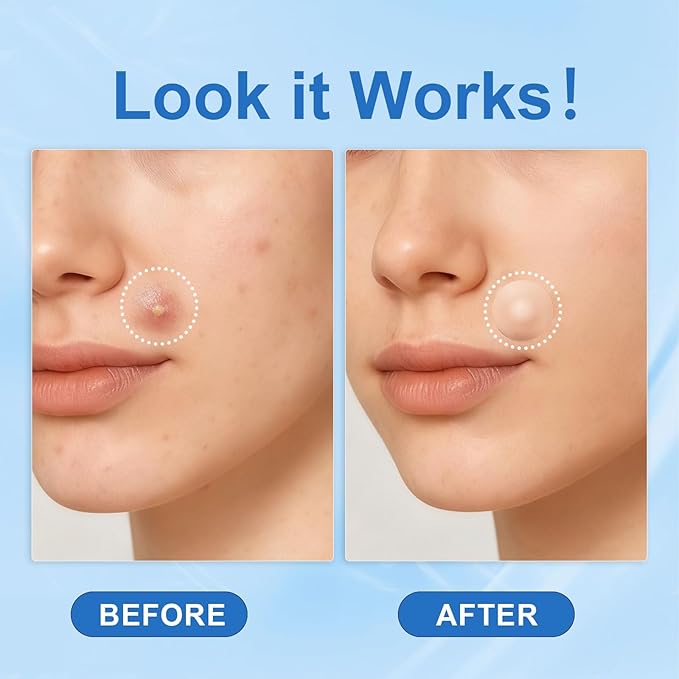 Amouy Acne Pimple Patch- 2 Sizes 432 Dots Thin & Thick Hydrocolloid Patches for Face with Witch Hazel, Tea Tree & Calendula Oil, Extra Adhesion Pimple Patches for Face Zit Patch Acne Dots