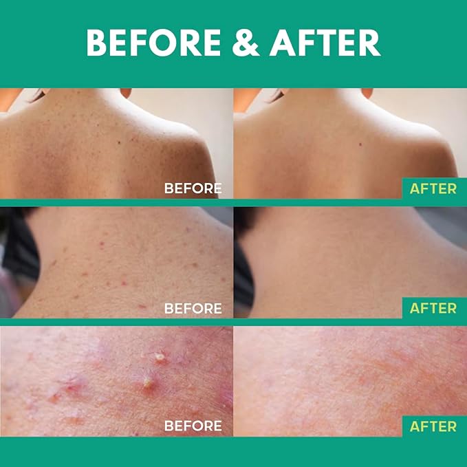 Back Acne Spray, Body Acne Treatment with Salicylic Acid, Tea Tree Oil & Niacinamide, 4 oz