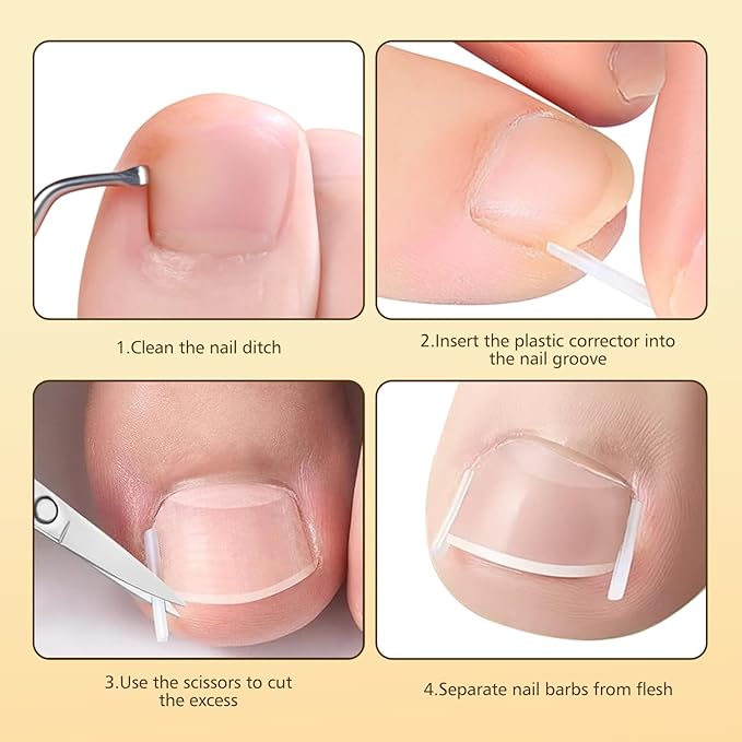 Ingrown Toenail Corrector Kit with Magnifier and Correction Strips, Professional Ingrown Toenail Treatment Tools Set, Safe and Effective Nail Care for Home Use