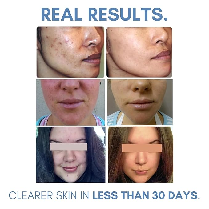 Clearogen Sensitive Skin Sulfur Acne Lotion, Acne Treatment, Sulfur Cream, Sulfur Ointment, Sulfur Spot Treatment, Sulfur Acne Treatment Cream 1.8 FL Oz