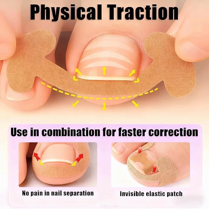 Ingrown toenail removal kit (Type A): Contains corrector, breathable/curved corrector strips, painless file, nail remover and pedicure tools, suitable for both men and women.