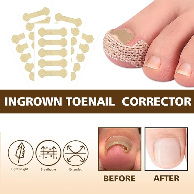Ingrown Toenail Corrector Kit with Magnifier and Correction Strips, Professional Ingrown Toenail Treatment Tools Set, Safe and Effective Nail Care for Home Use