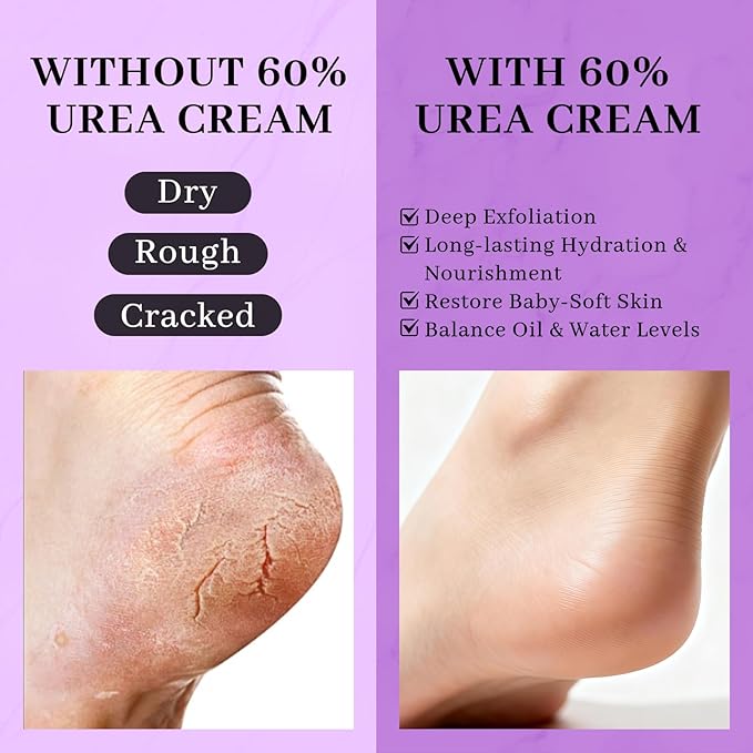 5-in-1 60% Urea Cream with 2% Salicylic Acid, Urea Cream 60 Percent for Feet & Hands- Maximum Strength Moisturizer for Rough, Dry, Thick & Cracked Skin, Callus Remover, Deep Hydration, 150g