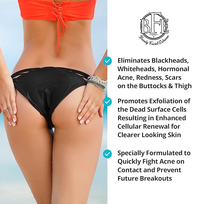 Anti-Acne Buttocks & Thigh Treatment- Clears Away Acne, Pimples, Zits, Dark Spots & Ingrown Hairs on the Buttocks &Thigh Area. Prevents Future Breakouts 6.9 OZ