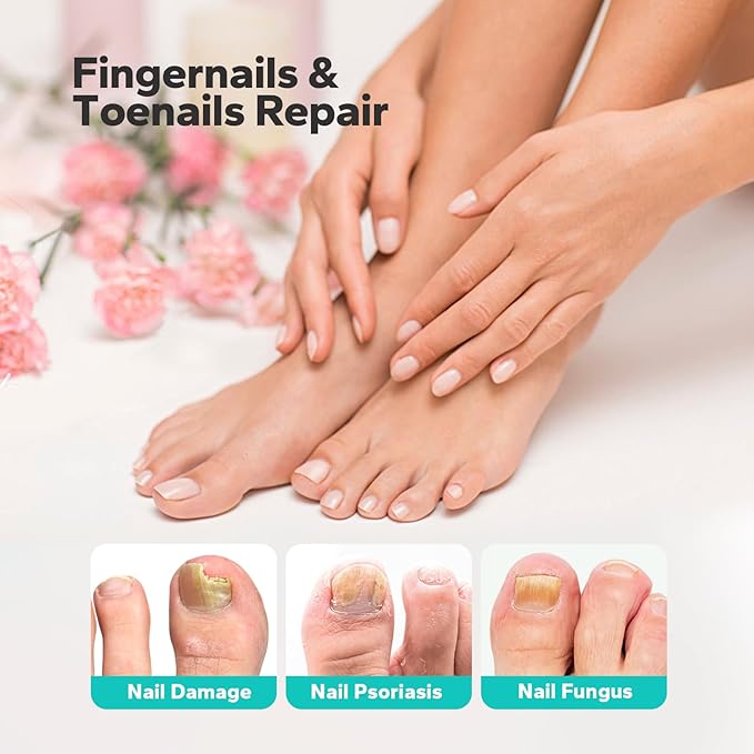 Choppie Extra Strength Nail Care Solution (1.69 Fl oz), Intensive Support for Hands & Feet, Foot Care Formula