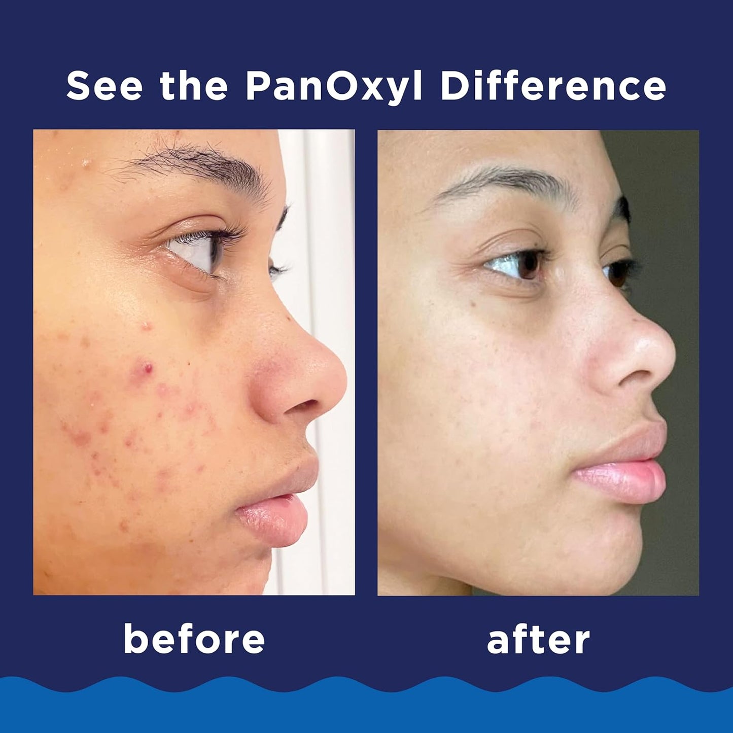 10% Benzoyl Peroxide Acne Foaming Wash, Maximum Strength, Daily Acne-Fighting Face and Body Cleanser, Face Wash to Clear, Treat and Prevent Acne Pimples and Stubborn Breakouts, 5.5 Oz Tube