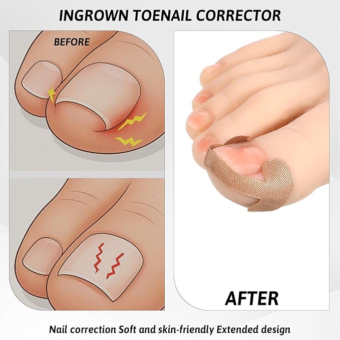 Professional Ingrown Toenail Corrector Set with Ingrown Toenail Strips, Curved Toenails Corrector Patch, Painless File and Lifter Pedicure Tools, Ingrowns Toenails Tools for Women and Man