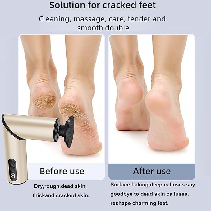 Chu&LiuXung Powerful Fold Electric Foot Callus Remover, Rechargable Callus Remover Tool with Sandpapers, 9 Adjustable Speed with 2-in-1 Grinding Heads for Calluses, Hard Skin, Cracks and Nails