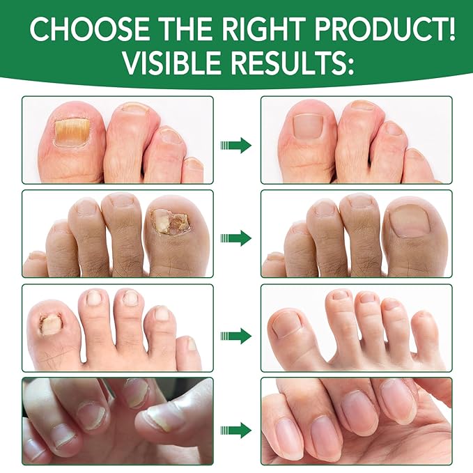 Toenail Treatment with 25% Undecylenic Acid, Nail Renewal, Promotes Nails Health,Enrich Jojoba Oil and Vitamin E Nourish Nail & Skin,Safe & Gentle Repairing Damaged Nails