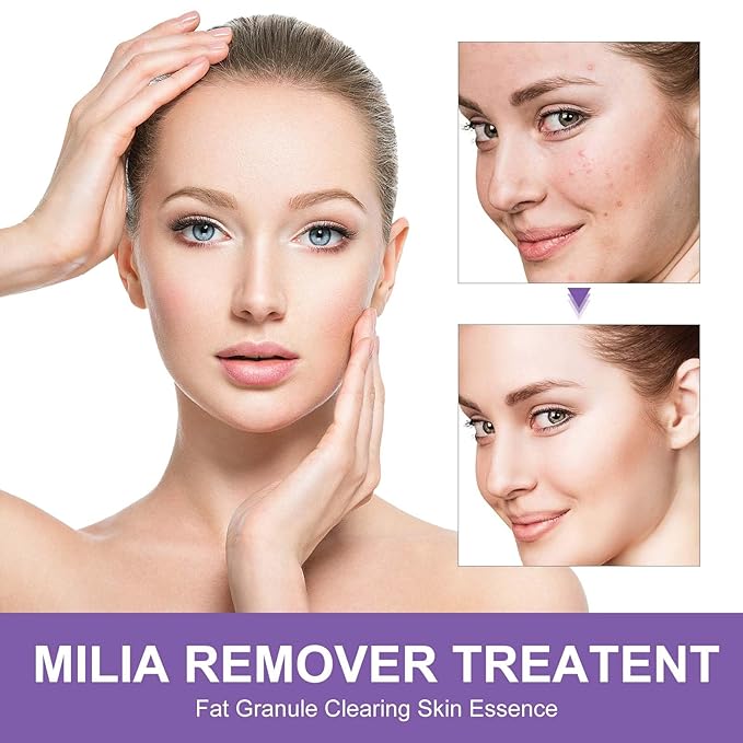 Milia Remover Serum for Eyes and Face, Milia Spot Remover with Salicylic Acid, Milia Acne Serum