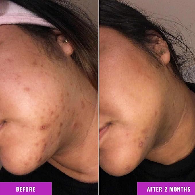Good Molecules Discoloration Correcting Serum Pack 2 – 30 ml Each | Tranexamic Acid & Niacinamide Serum to Target Dark Spots and Hyperpigmentation, Skin Care for Face