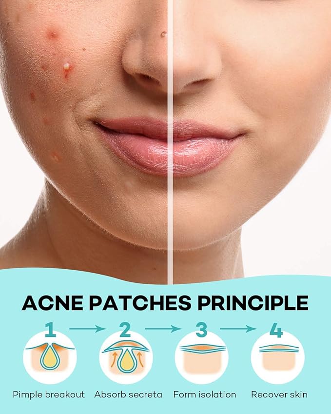 TKTK Pimple Patch Acne Patch, 4 Sizes 560 Patches Acne Absorbing Cover Patch, Hydrocolloid Invisible Acne Patches For Face Zit Patch Acne Dots Tea Tree, Calendula Oil - 4 Pack