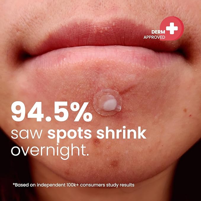 ROSELYNBOUTIQUE Pimple Patches for Face (60Ct - 4 Sizes 8,10,12,14mm) - Hydrocolloid Acne Spot Patches Blemishes Pore Strips - Vegan Facial Korean Skin Care Products Cruelty-Free (60 Dots)